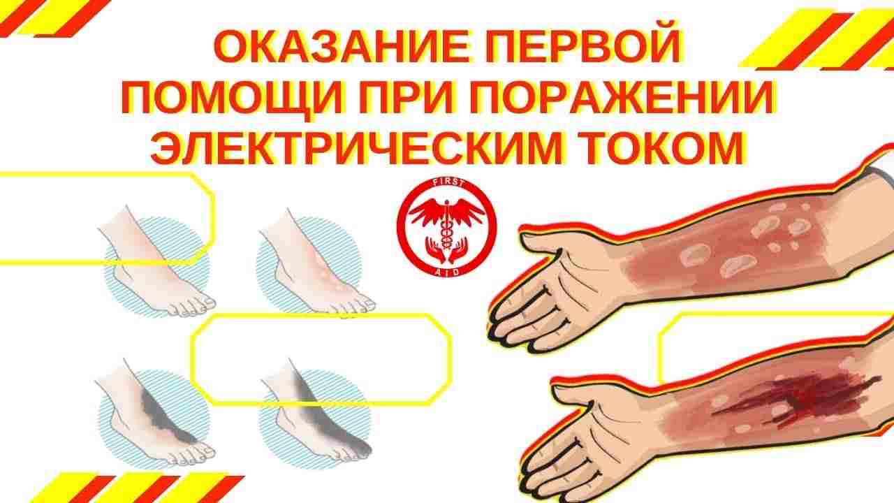 1 помощь при поражении электрическим током