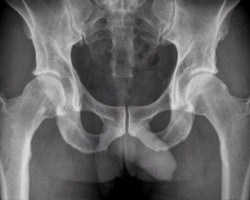 артроз тазобедренного сустава 2 степени лечение