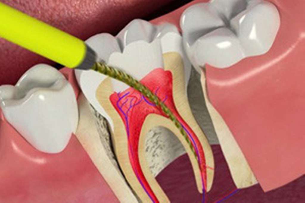 болит зуб при нажатии на него