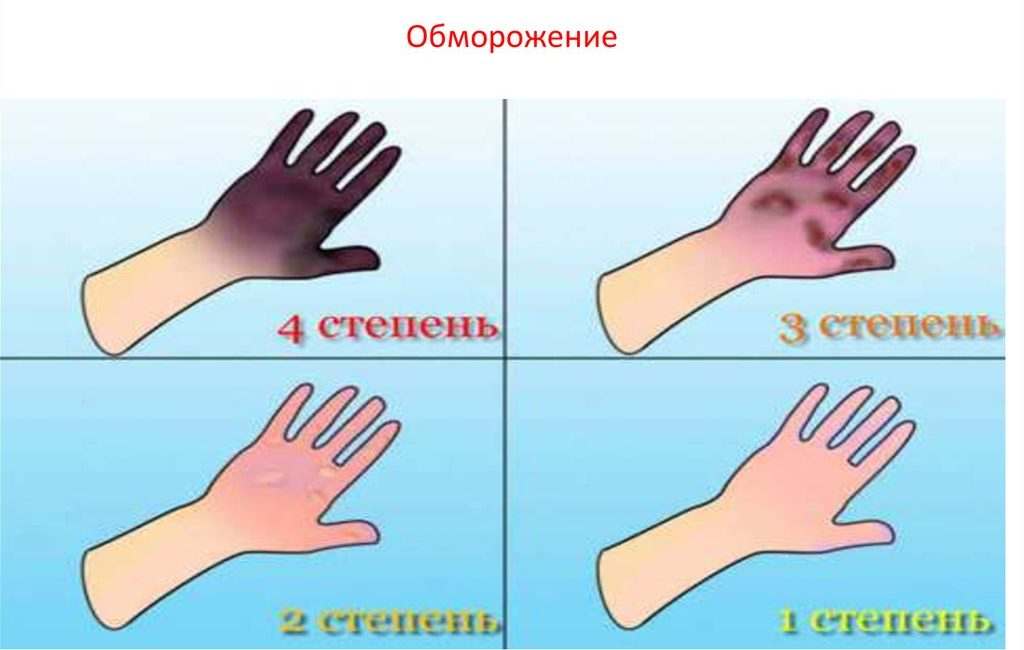 в случае развития отморожения конечности наиболее важно