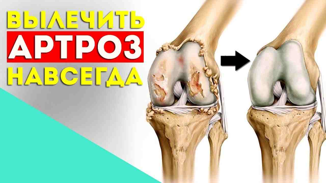 гонартроз коленного сустава что это такое лечение