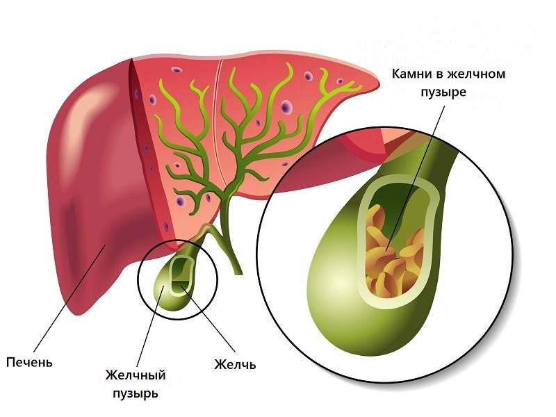 желчекаменная болезнь симптомы и лечение