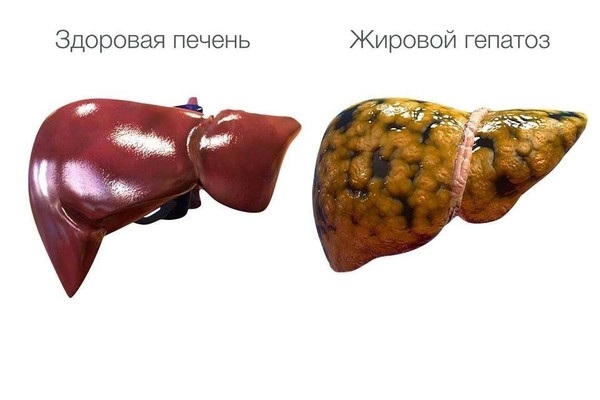 жировой гепатоз печени что это такое