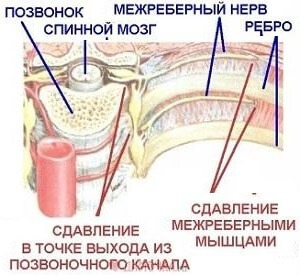 как лечить межреберную невралгию справа