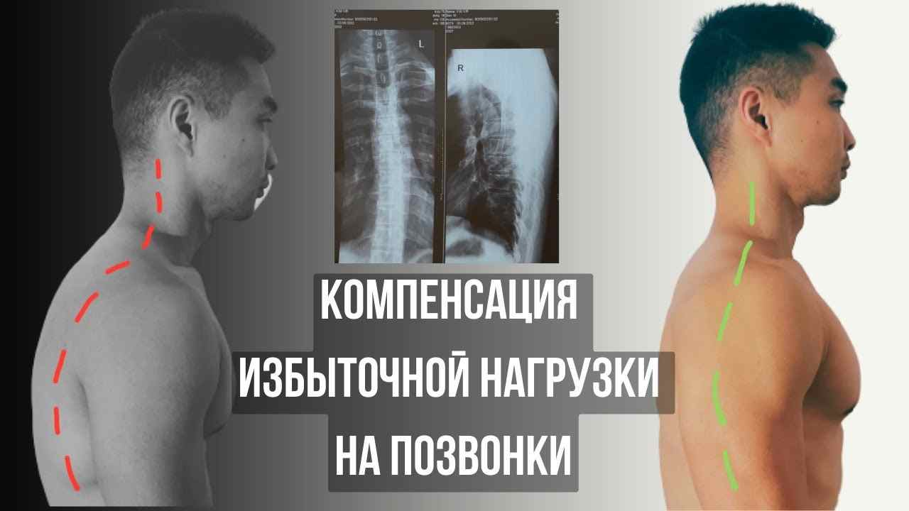 как можно предупредить развитие искривления позвоночника
