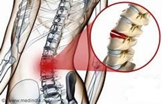 компрессионный перелом позвоночника что это