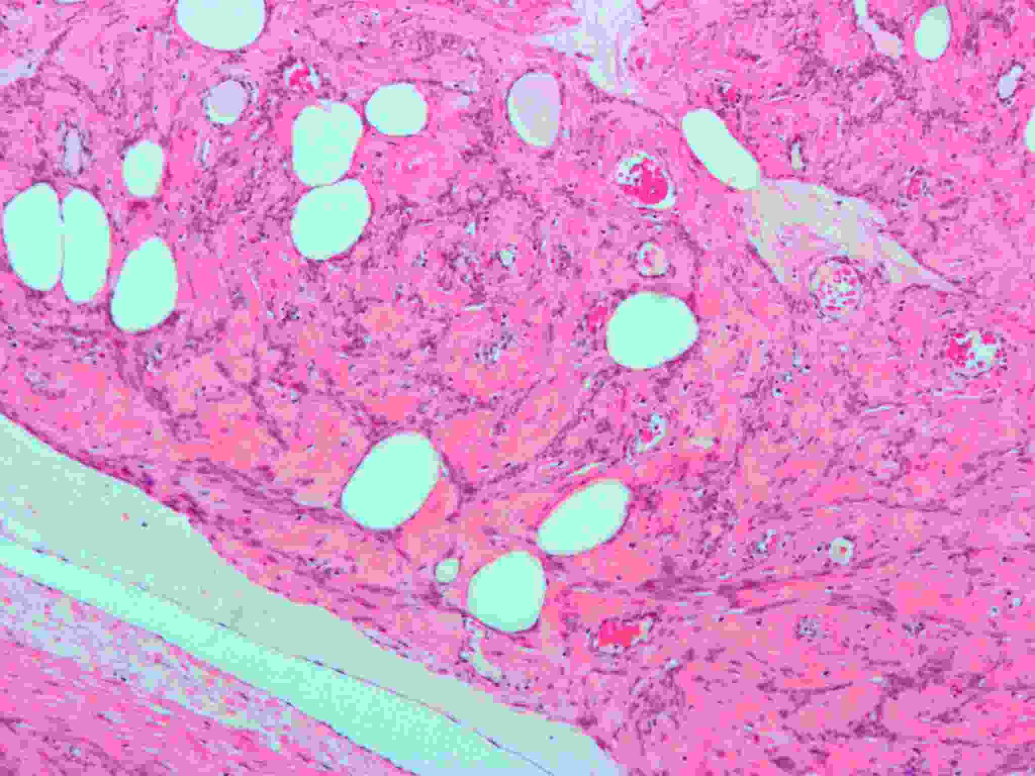 лейомиома матки что это такое