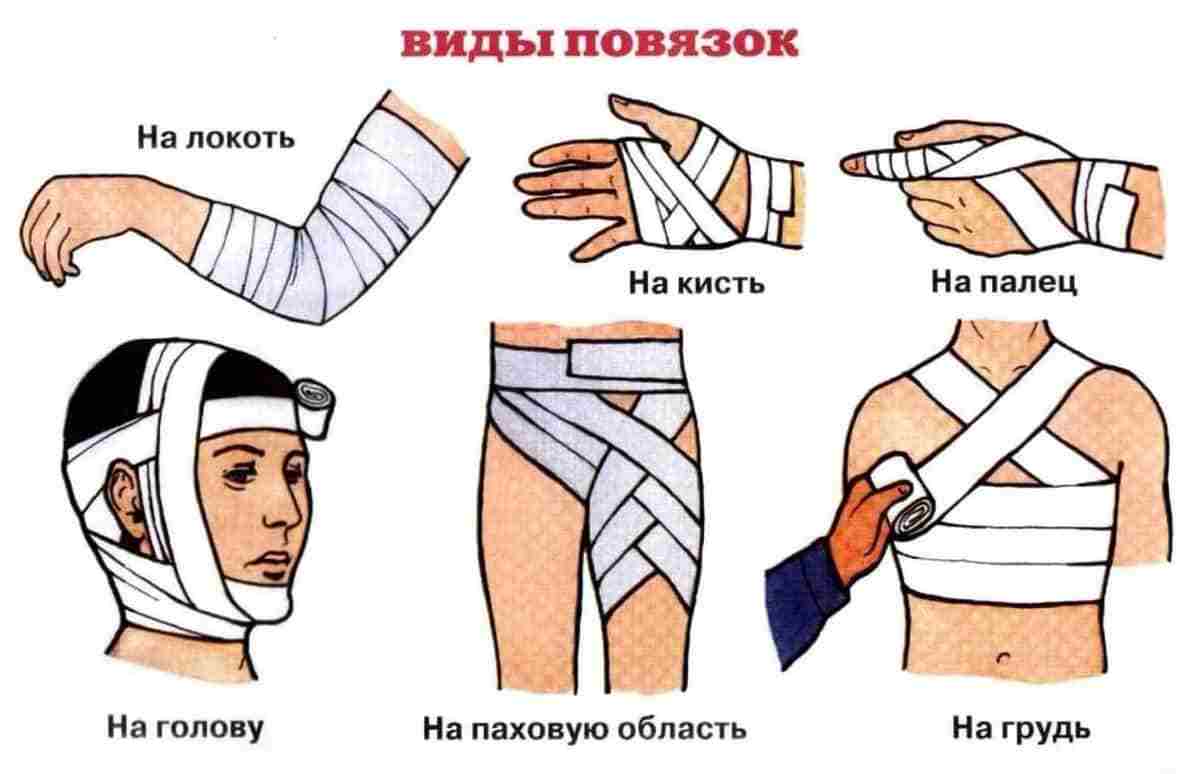 окклюзионная повязка применяется при ранении