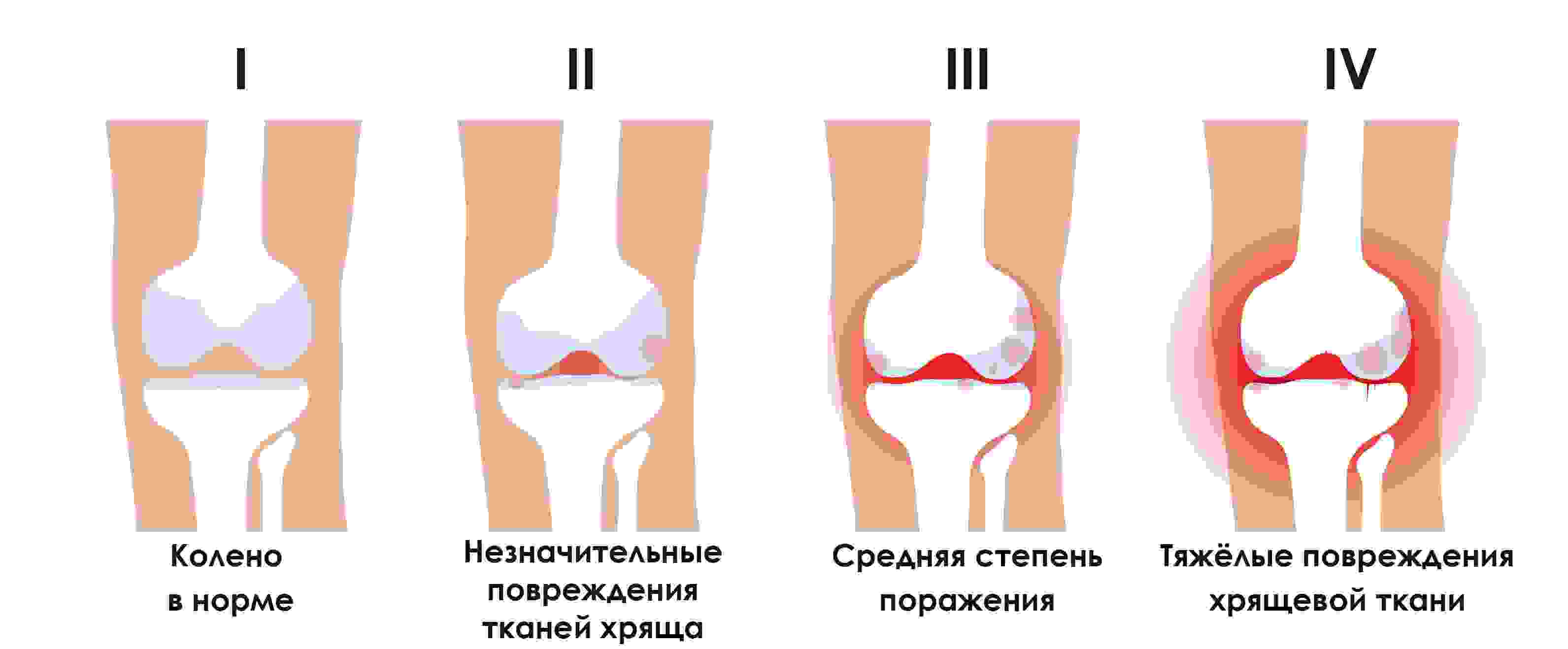 остеоартроз коленного сустава 1 степени