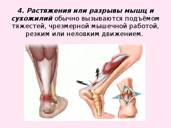 потянула мышцу на ноге что делать