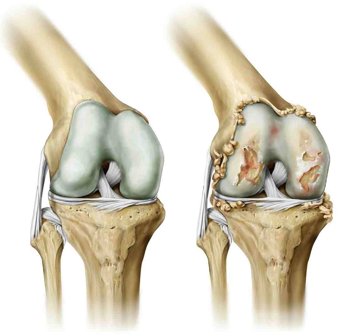 при артрозе суставов больше двигаться или лежать