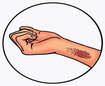 признаками артериального кровотечения являются ответ