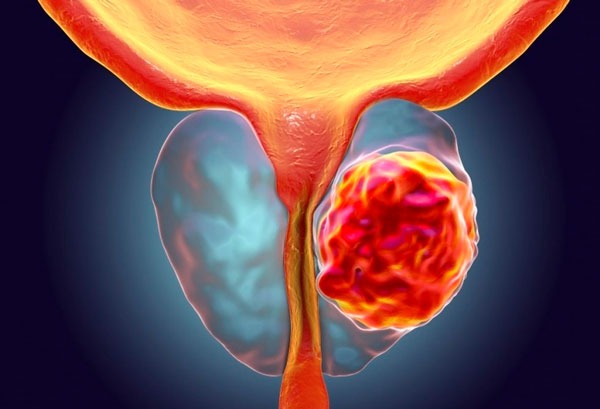 рак предстательной железы клинические рекомендации