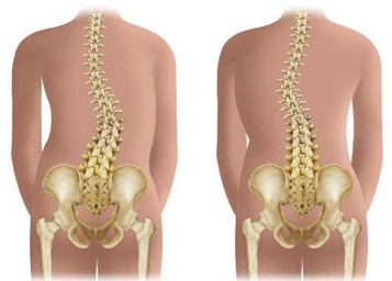 сколиоз 1 степени что это