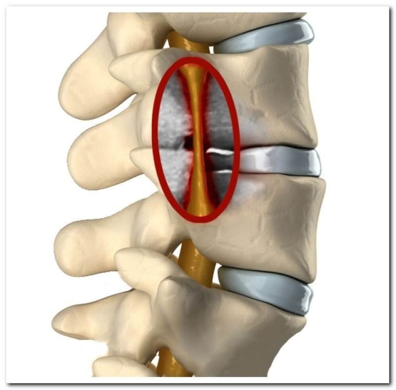 стеноз позвоночного канала поясничного отдела лечение