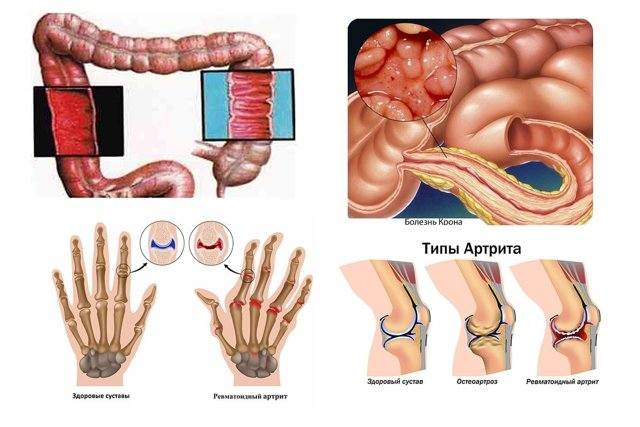 сульфасалазин инструкция по применению цена отзывы