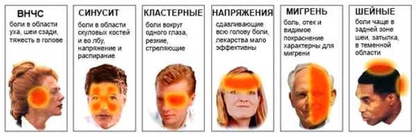 таблетки от мигрени и головной боли