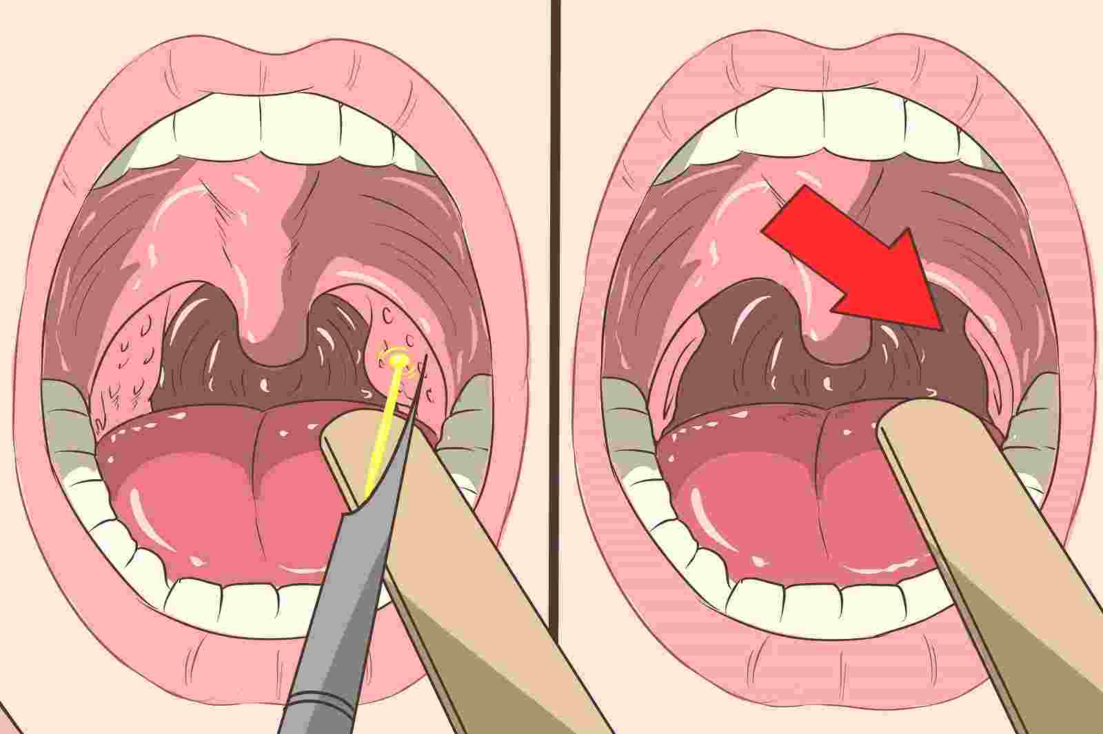 тонзилосепт инструкция по применению отзывы цена