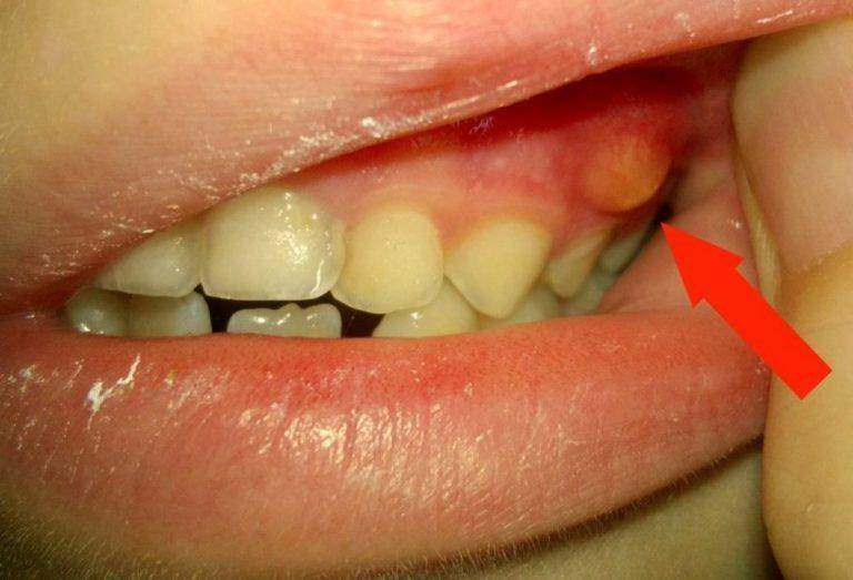 что делать если болят десна зубов