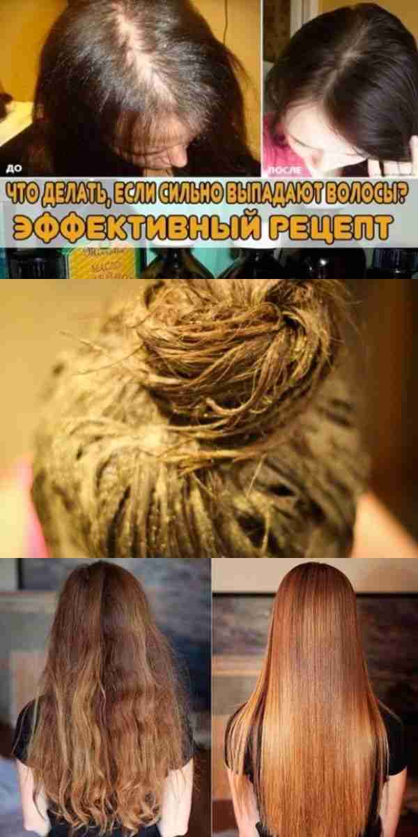 что делать если сильно выпадают волосы