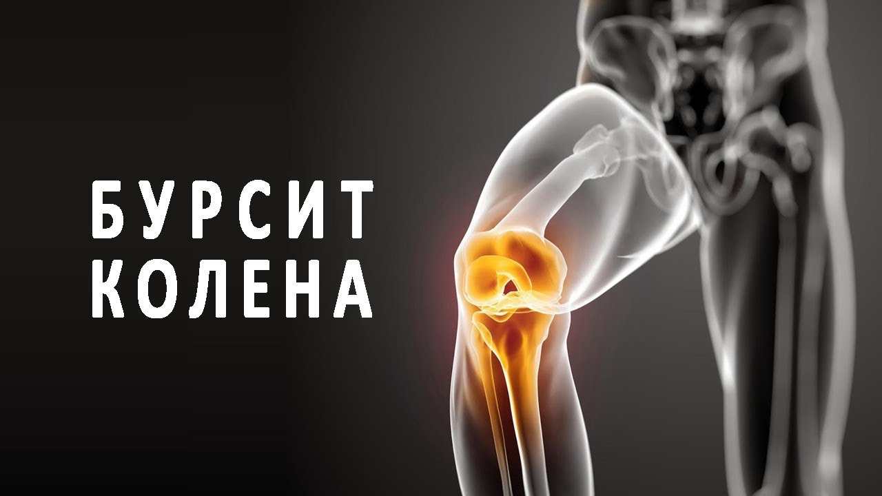 что такое бурсит коленного сустава
