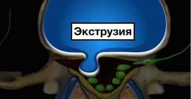 экструзия дисков позвоночника что это такое