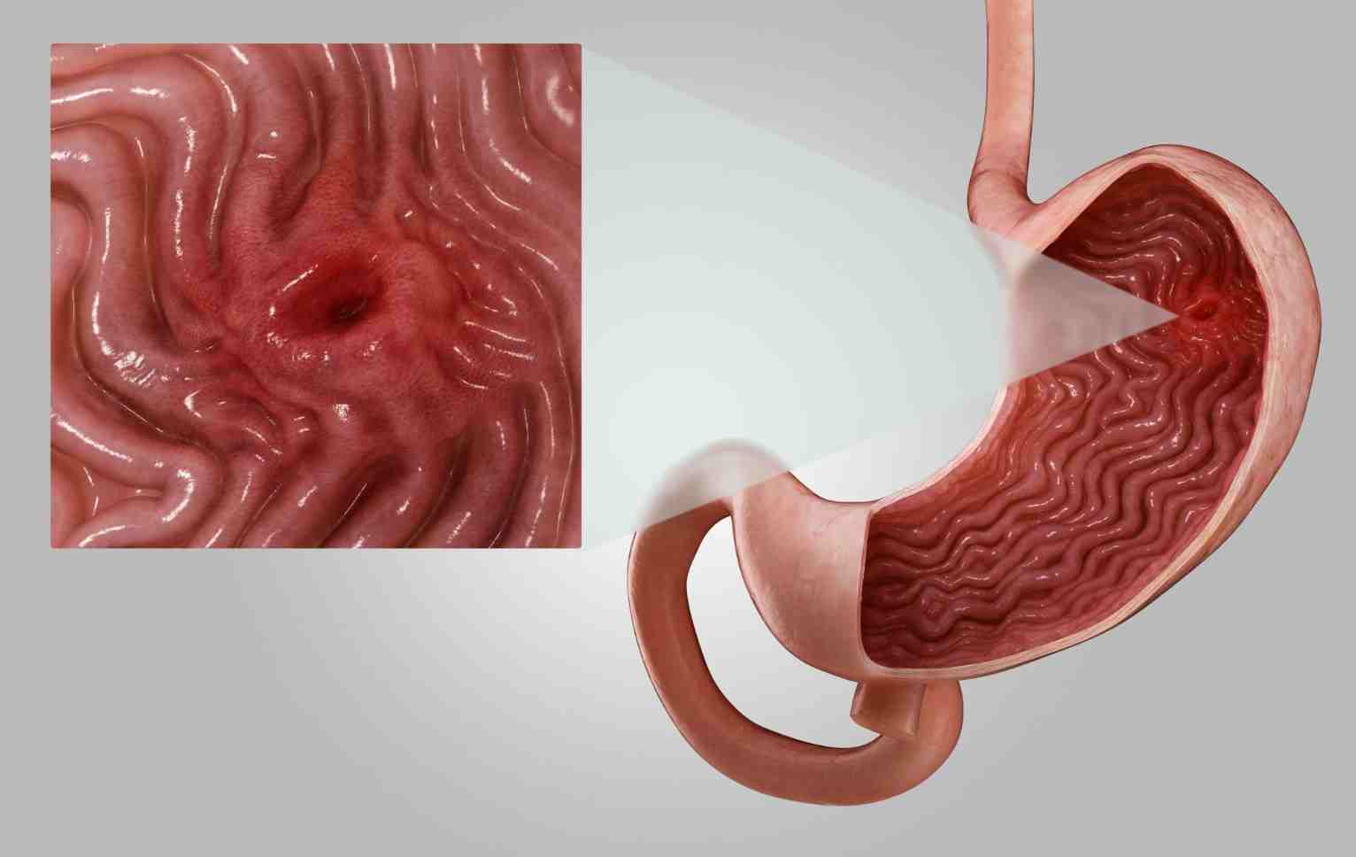 язва желудка симптомы при обострении и лечение