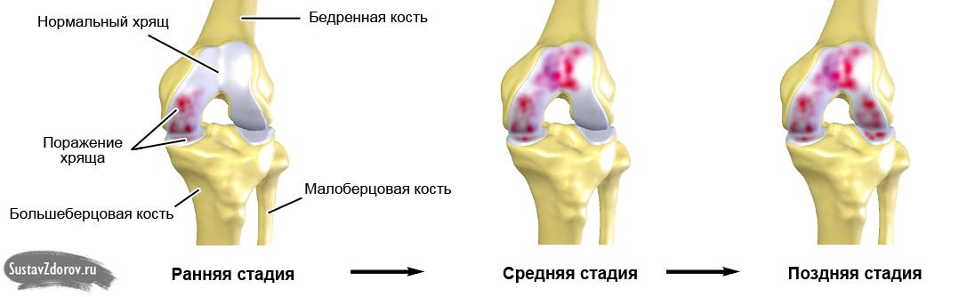 артрит коленного сустава симптомы и лечение