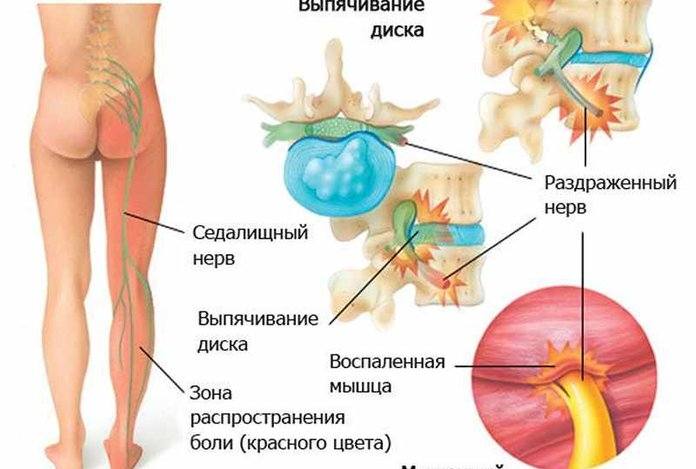 воспаление седалищного нерва симптомы и лечение