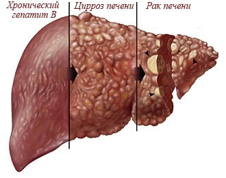 гепатит б что это за болезнь симптомы