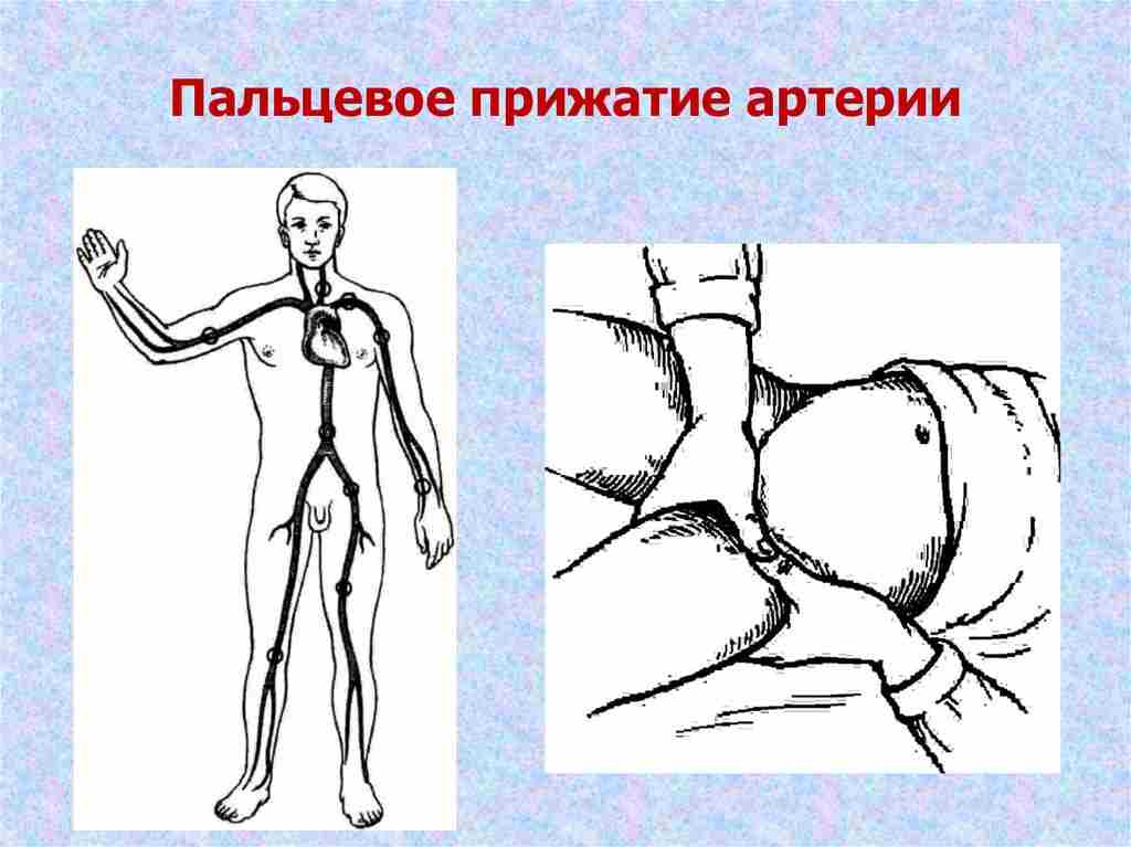 для временной остановки артериального кровотечения необходимо выполнить