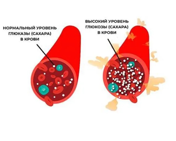 из за чего появляется диабет