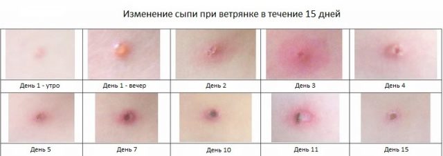 как начинается ветрянка у детей