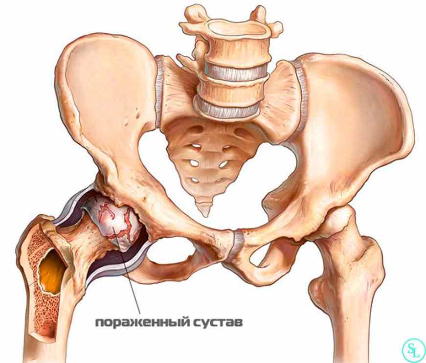 коксартроз тазобедренного сустава что это