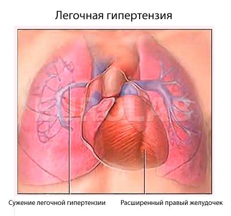 легочная гипертензия что это такое