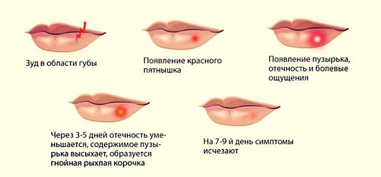 мазь от герпеса на губах самая эффективная