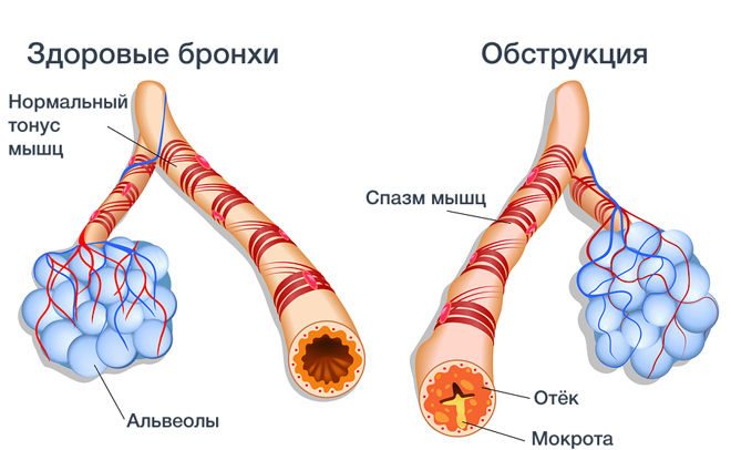 обструктивный бронхит у взрослых симптомы и лечение