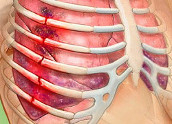 перелом ребер симптомы и лечение