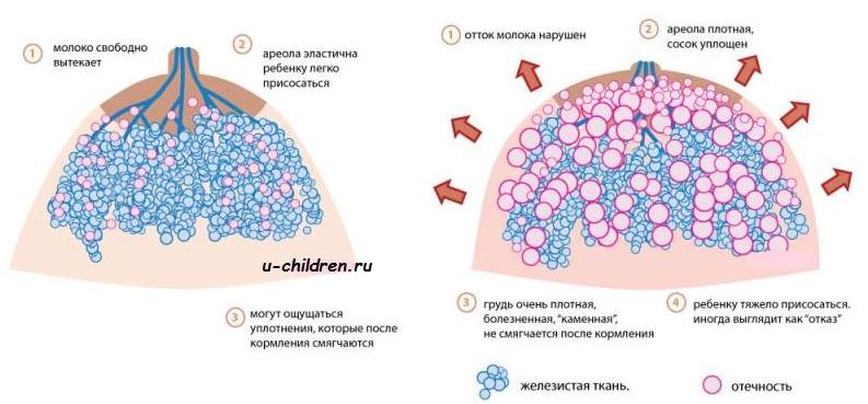 почему одна грудь больше другой