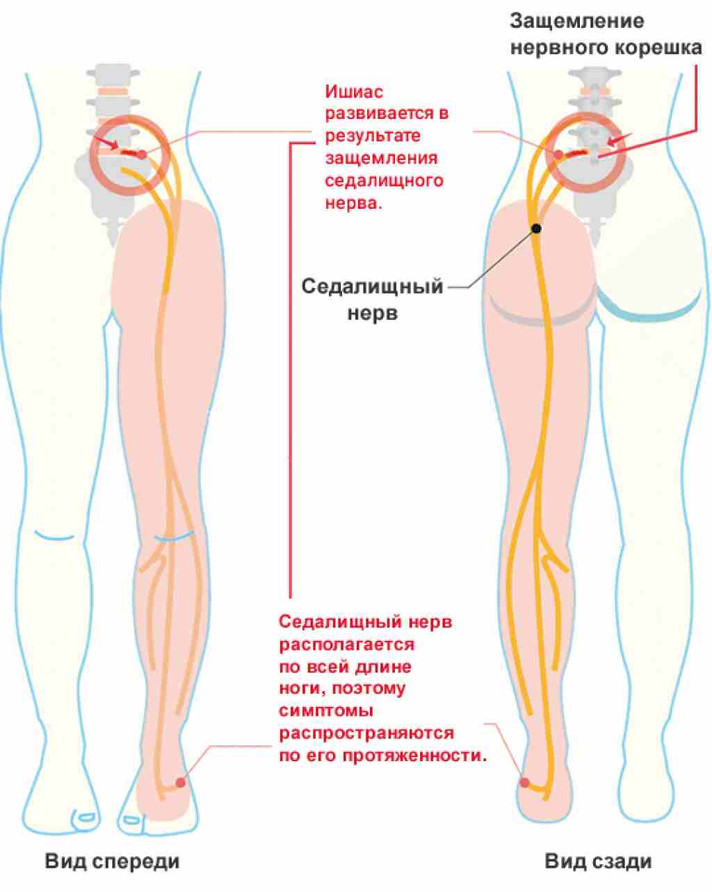 седалищный нерв воспаление симптомы и лечение