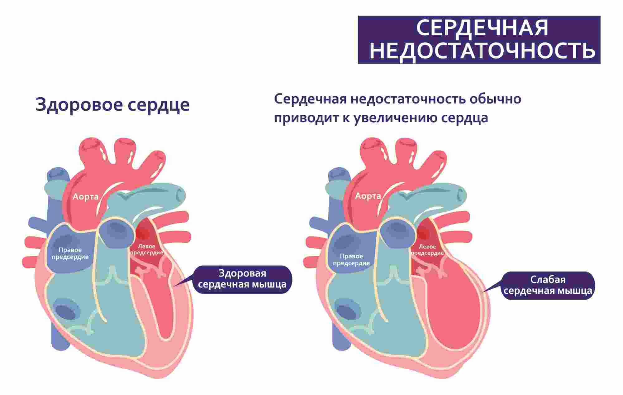 сердечная недостаточность что это такое