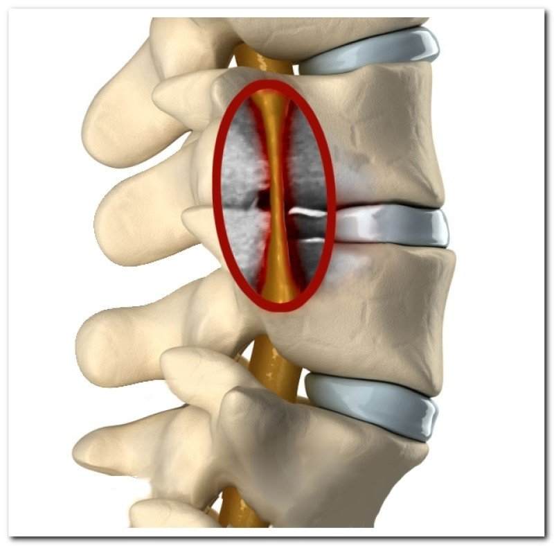 стеноз позвоночного канала поясничного отдела что это