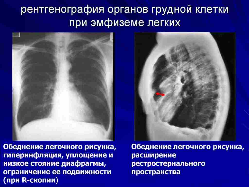 что такое эмфизема легких простыми словами