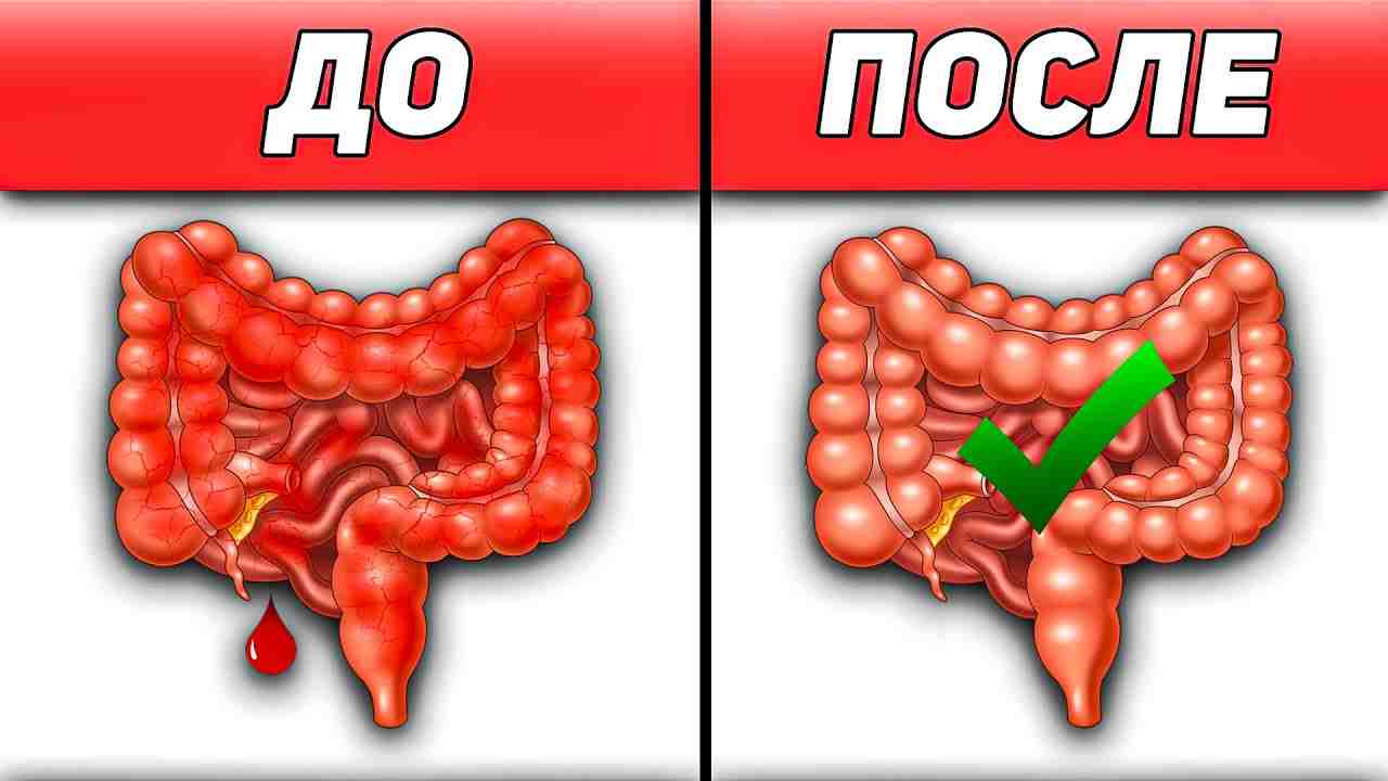 язвенный колит клинические рекомендации 2024